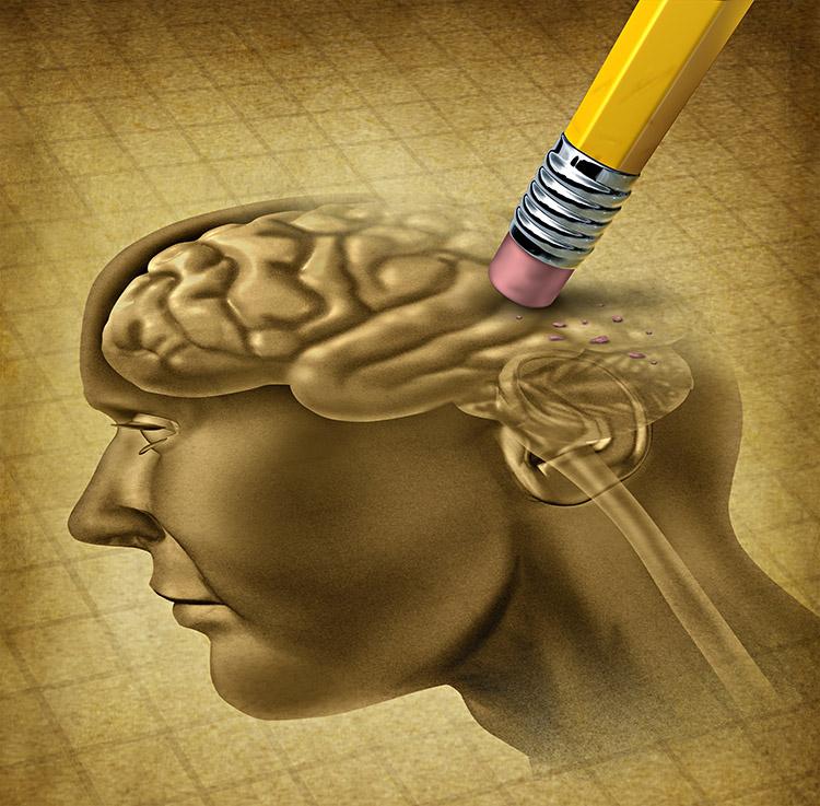 5 respostas sobre Alzheimer – Tire suas dúvidas! 