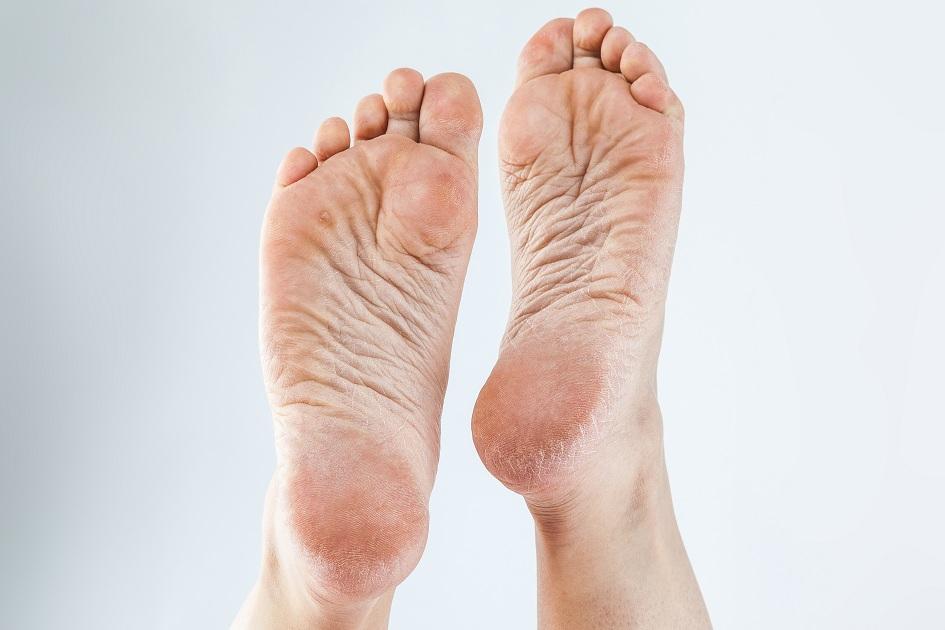 Pé rachado: 5 soluções caseiras para acabar com o problema 