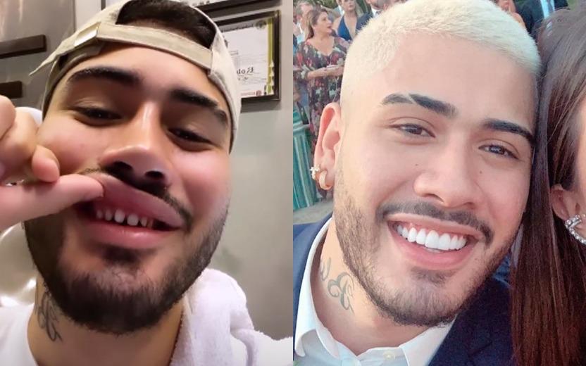 Lente de contato dental: conheça o procedimento feito pelo cantor Kevinho 
