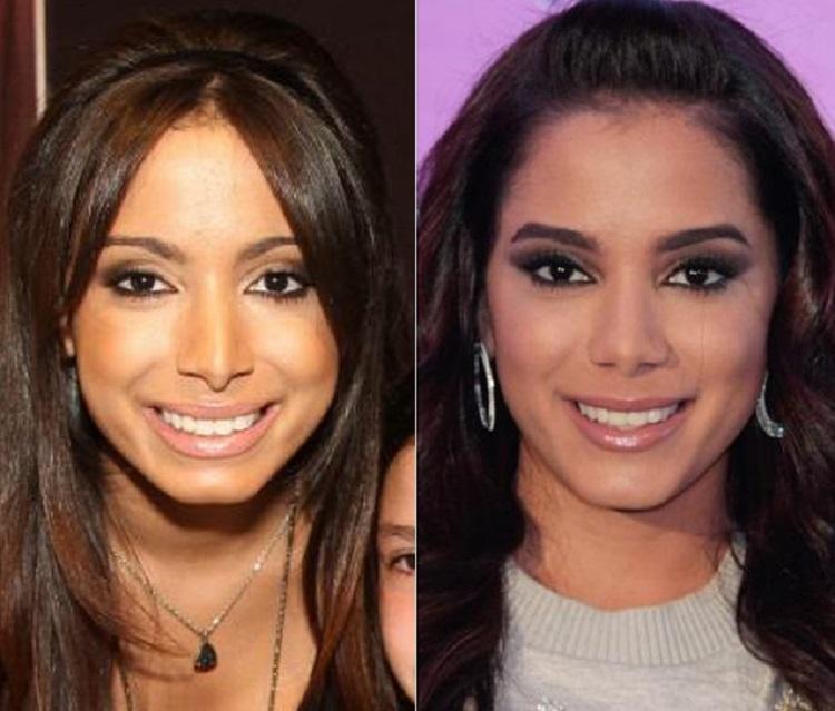 anitta nariz antes e depois da cirurgia