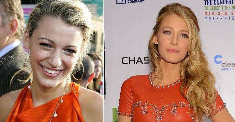 blake lively antes e depois da cirurgia do nariz