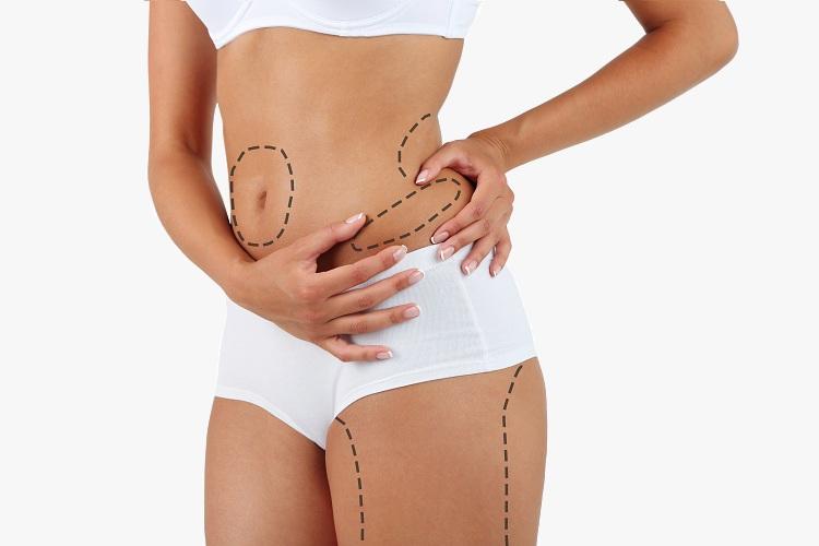 mulher com marcações de lipoaspiração