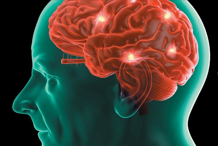 cerebro vermelho idoso alzheimer