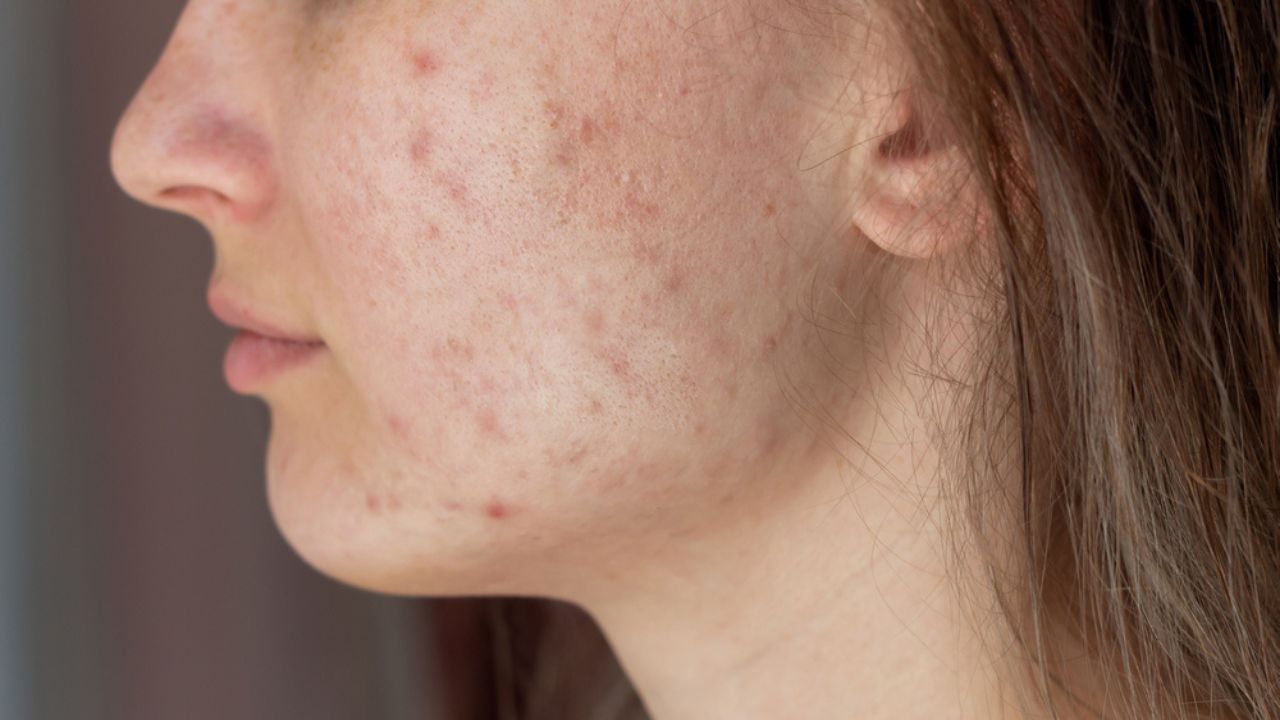 As lesões da acne adulta surge em locais como bochechas e queixo