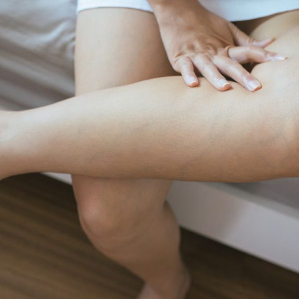 Cirurgião vascular alerta sobre riscos para as doenças circulatórias e orienta cuidados simples para evitar varizes e inchaços