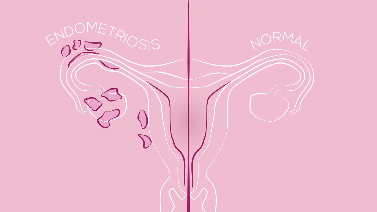 Saiba os principais exames para diagnosticar a endometriose