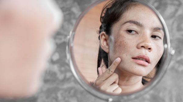 O melasma não oferece riscos à saúde, mas impacta a autoestima