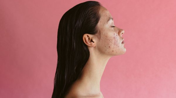 Acne pós-chip da beleza: saiba os cuidados para controlar condição