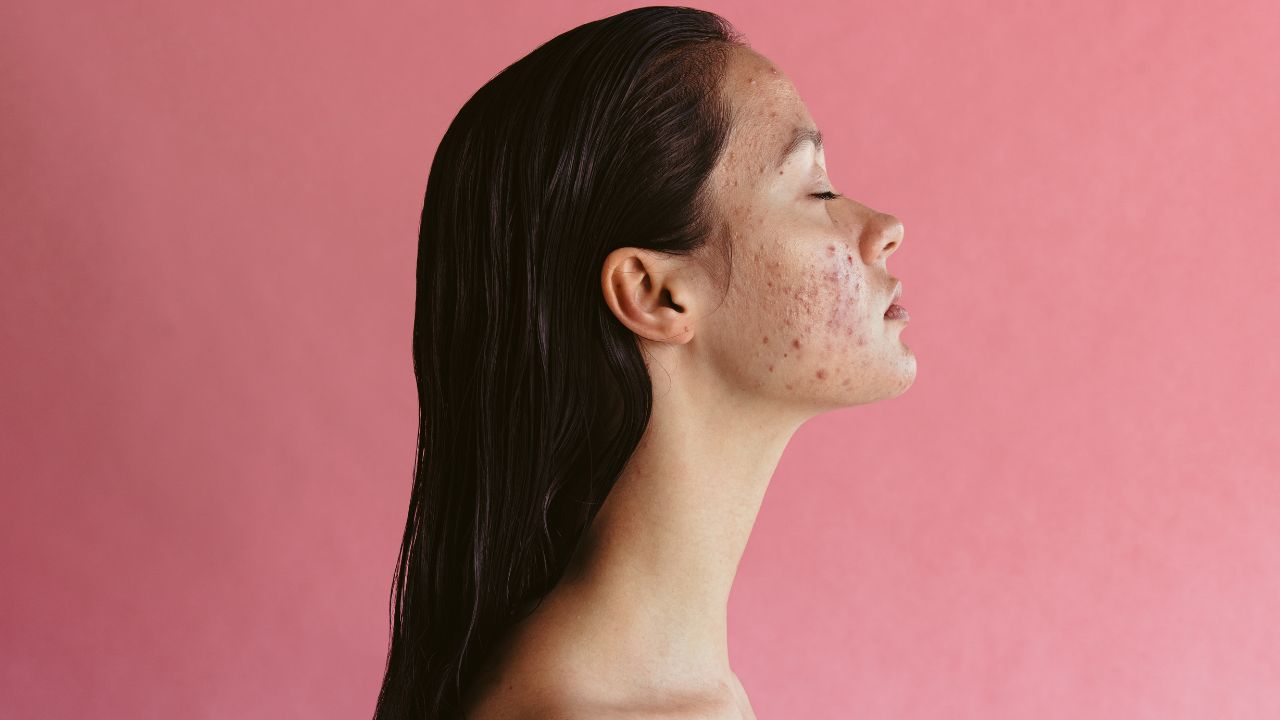 Acne pós-chip da beleza: saiba os cuidados para controlar condição