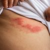 Herpes zóster: conheça os mitos e verdades sobre a doença