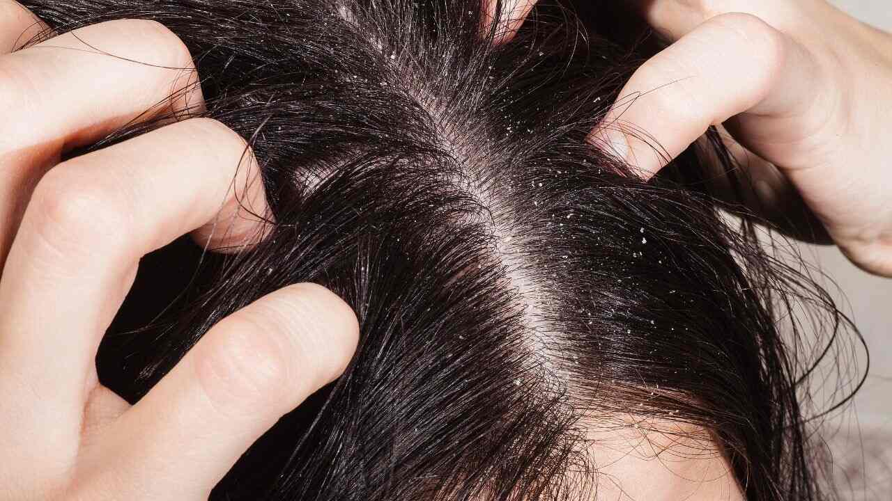 Dermatite seborreica: causas, sintomas e como controlar