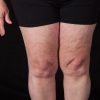 Lipedema: conheça as formas de tratamentos para a doença