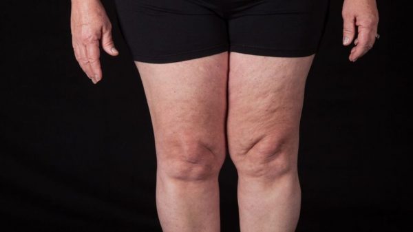 Lipedema: conheça as formas de tratamentos para a doença