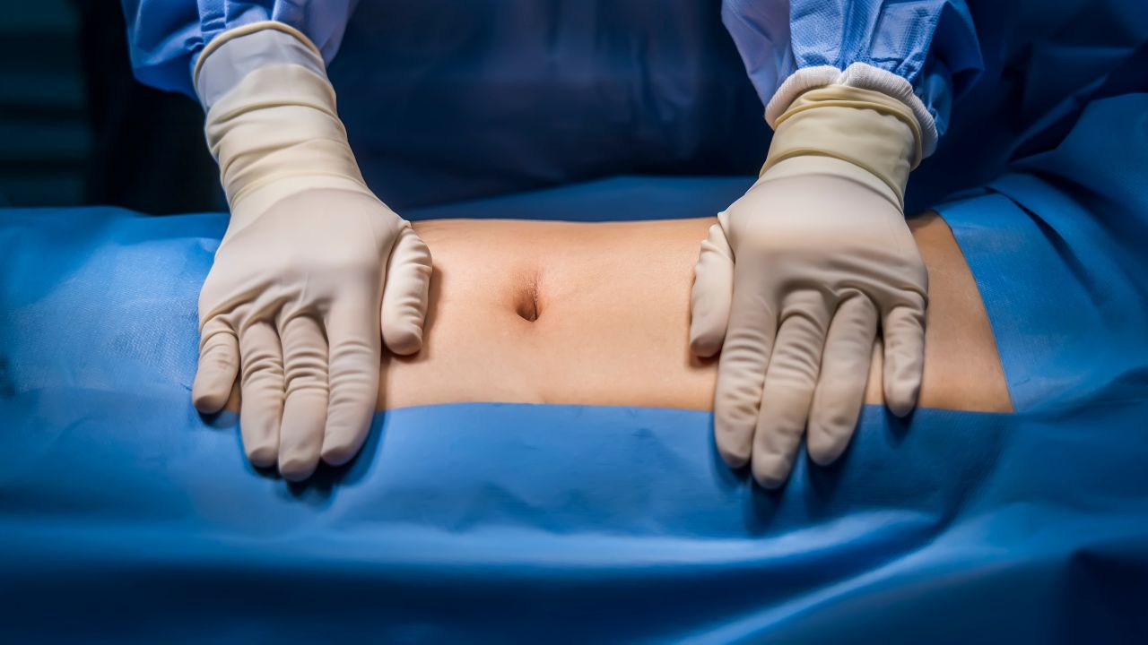 Saiba quais os riscos da gravidez após abdominoplastia e se os resultados da cirurgia são afetados