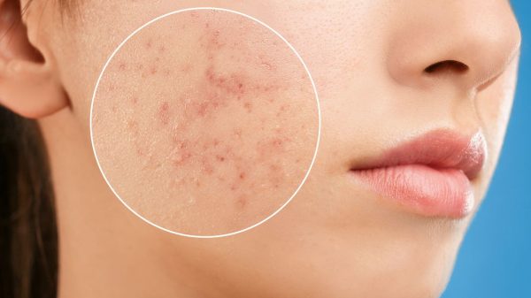 Entenda a relação entre acne e saúde mental