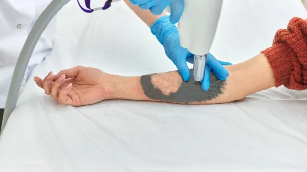 Saiba tudo sobre a remoção de tatuagem com laser