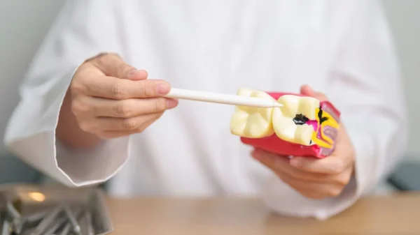 O diagnóstico tardio da cárie oculta pode levar a problemas mais sérios, como infecções bucais e exigir até a extração do dente