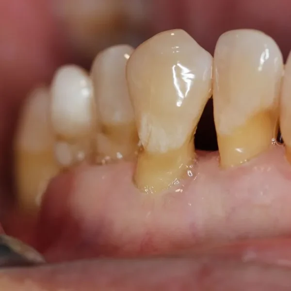 Decorrente de uma escovação inadequada e inflamações na gengiva, a retração gengival causa dor e sensibilidade nos dentes