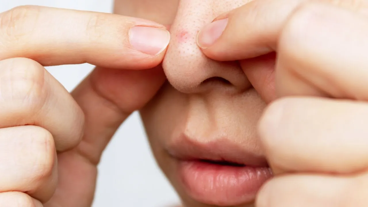 Causados pelo excesso de produção de sebo na pele, os cravos podem ser tratados com cuidados de skincare e procedimentos estéticos