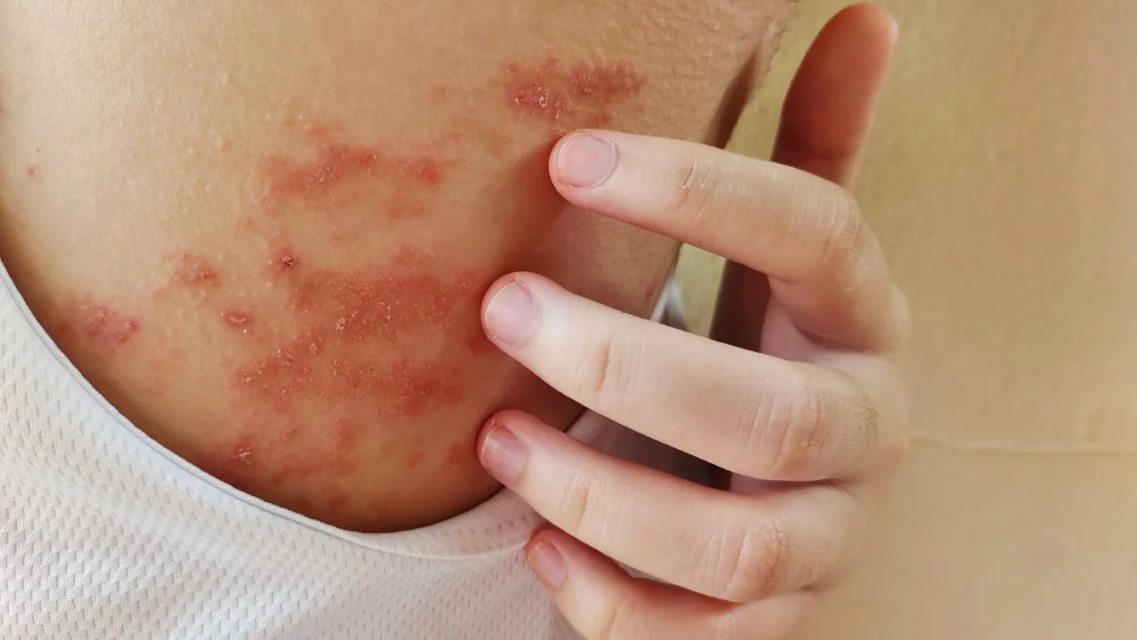 A dermatite atópica é uma condição dermatológica crônica que tem impacto significativo na qualidade de vida do portador