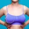 Especialista explica quais hábitos podem agravar a ptose mamária e cuidados para prevenir o problema