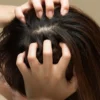 Acne no couro cabeludo pode sinalizar desequilíbrios invisíveis e exige tratamento adequado