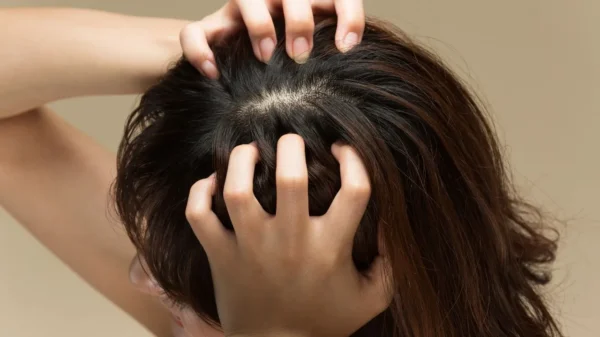 Acne no couro cabeludo pode sinalizar desequilíbrios invisíveis e exige tratamento adequado