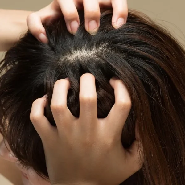 Acne no couro cabeludo pode sinalizar desequilíbrios invisíveis e exige tratamento adequado