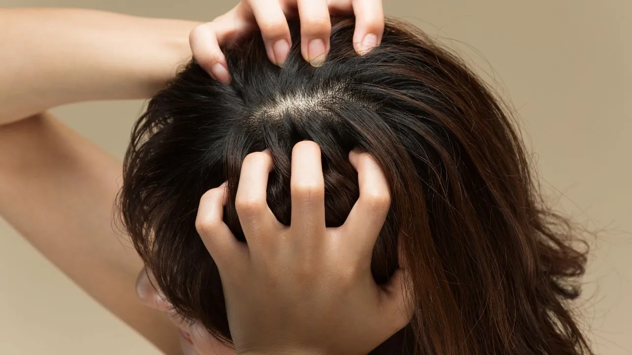 Acne no couro cabeludo pode sinalizar desequilíbrios invisíveis e exige tratamento adequado
