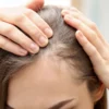 Médica explica como cada técnica funciona e de que forma atuam na saúde do couro cabeludo do paciente com alopecia