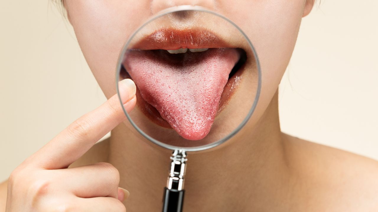 Frenectomia é um procedimento que ajuda quem tem língua presa