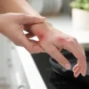 Especialista explica o que é necessário fazer para evitar complicações em caso de queimaduras na região das mãos