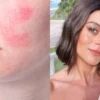 Atriz compartilhou em suas redes sociais que sofre com a doença inflamatória da pele; entenda os efeitos, sintomas e tratamento