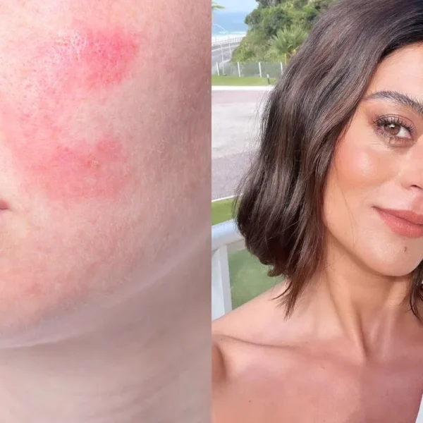 Atriz compartilhou em suas redes sociais que sofre com a doença inflamatória da pele; entenda os efeitos, sintomas e tratamento