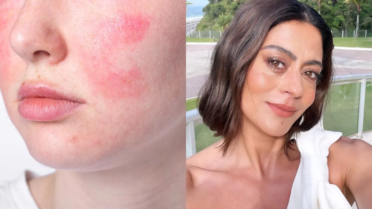 Atriz compartilhou em suas redes sociais que sofre com a doença inflamatória da pele; entenda os efeitos, sintomas e tratamento