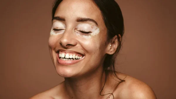 Condição não contagiosa, o vitiligo pode ser desencadeado ou agravado por fatores emocionais
