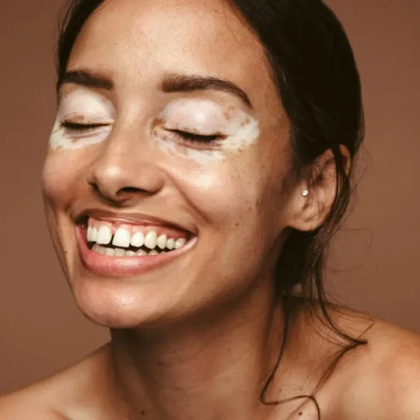 Condição não contagiosa, o vitiligo pode ser desencadeado ou agravado por fatores emocionais