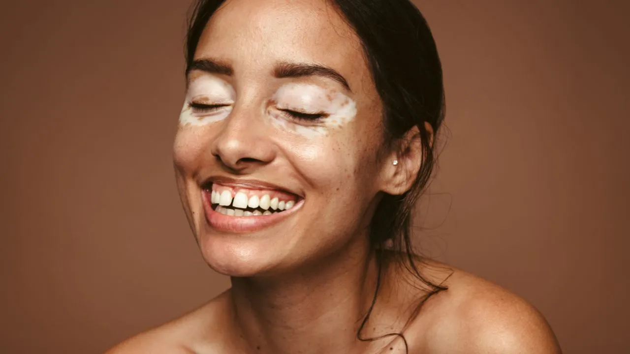 Condição não contagiosa, o vitiligo pode ser desencadeado ou agravado por fatores emocionais