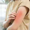Veja como descobrir e lidar com a alergia a camarão