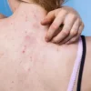 Saiba os fatores que contribuem para as espinhas nas costas e as medidas que devem ser tomadas para prevenir o surgimento delas