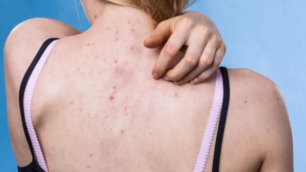 Saiba os fatores que contribuem para as espinhas nas costas e as medidas que devem ser tomadas para prevenir o surgimento delas